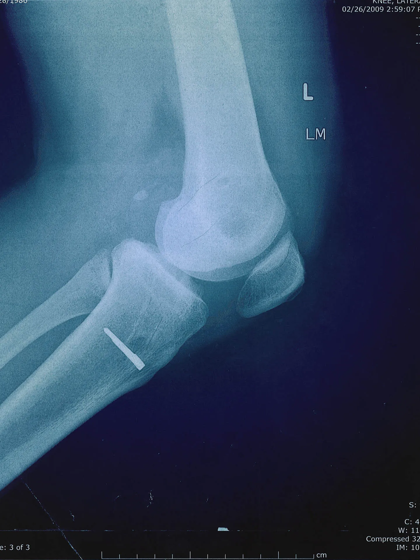 An x-ray from what would be my second knee surgery